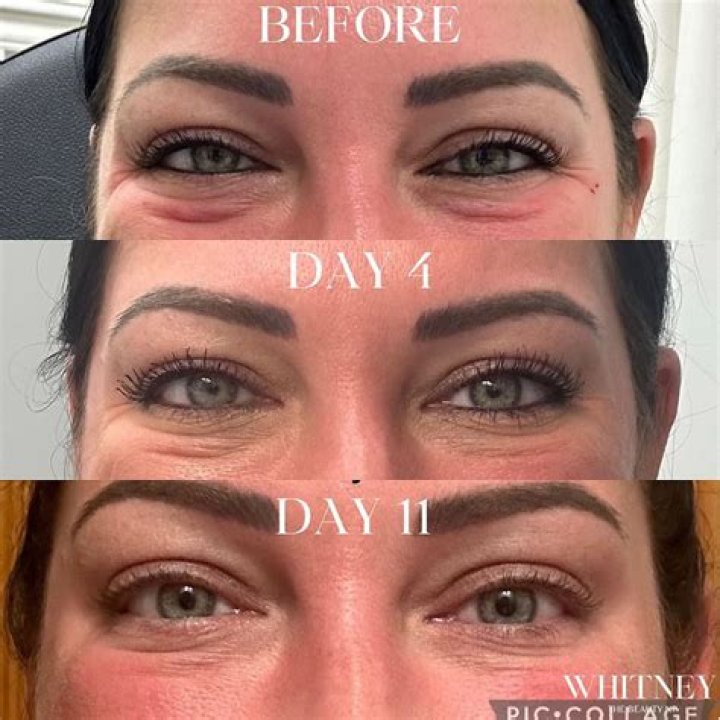 Unveiling The Secrets Of Jellyroll Botox: Discoveries And Insights Await